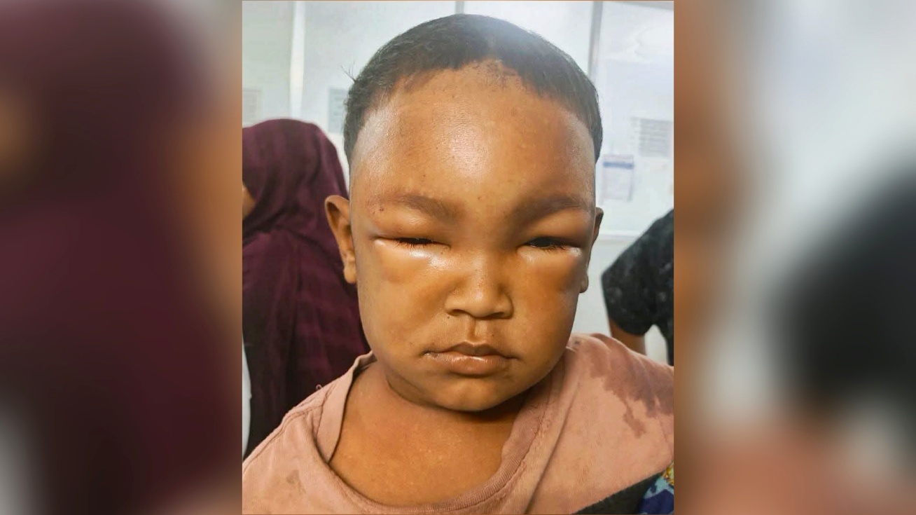 ভিমরুলের কামড়ে চকরিয়ায় শিশুর মৃত্যু, আহত ২